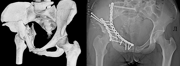 В Ярославле пять человек получили травмы, катаясь с горок