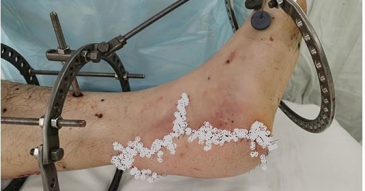 Полностью воссоздано ахиллово сухожилие: ярославские врачи провели уникальную операцию_240384